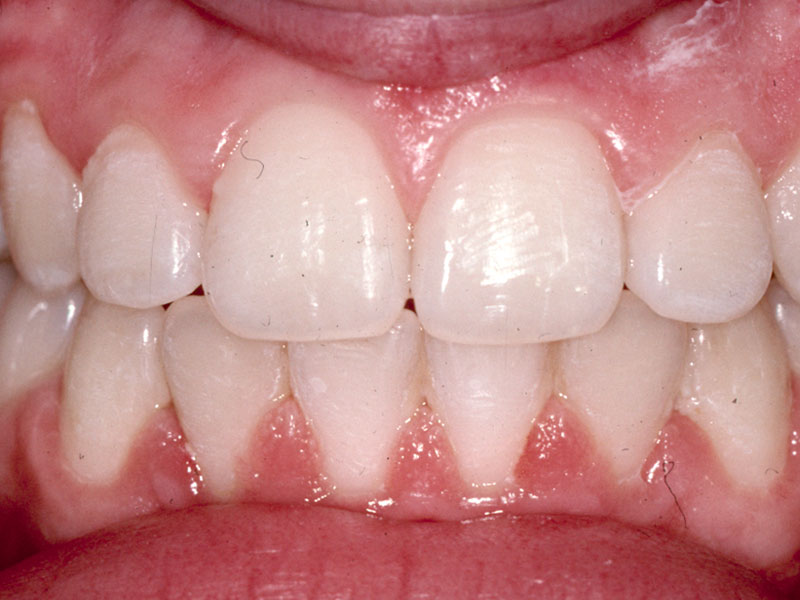 Pt3after