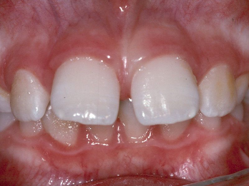 Pt4before
