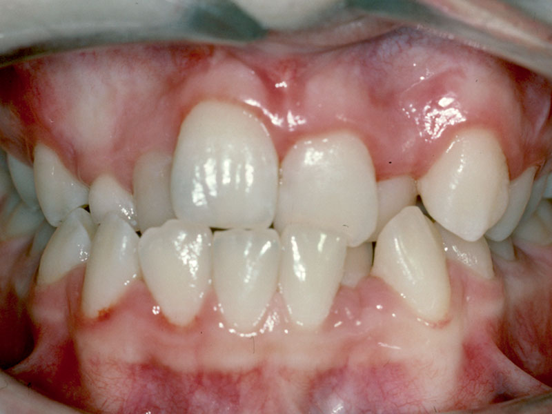 Pt5before